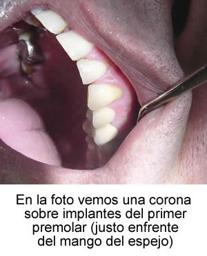Corona sobre implantes del primer premolar
