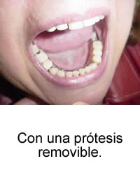 Con una prótesis removible