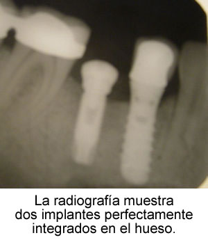 Radiografía muestra dos implantes perfectamente integrados en el hueso