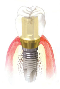 Implantes dentales
