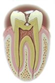 Proceso de la caries dental