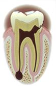 Avance de la caries