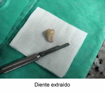 Diente extraído