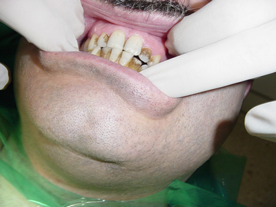 Limpieza dental y sarro