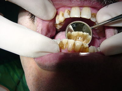 Razones para una limpieza dental