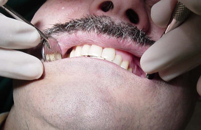 Cómo se hace la limpieza dental
