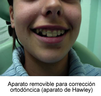Aparato removible para corrección ortodóncica