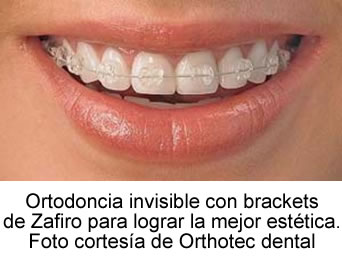Ortodoncia invisible con brackets de zafiro