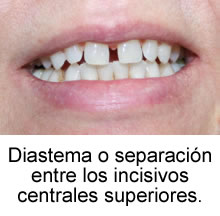 Diastema o separación entre los incisivos centrales superiores