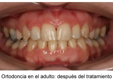 Ortodoncia en el adulto: después del tratamiento