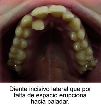 Diente incisivo lateral que por falta de espacio erupciona hacia paladar