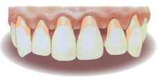 Enfermedad periodontal o piorrea