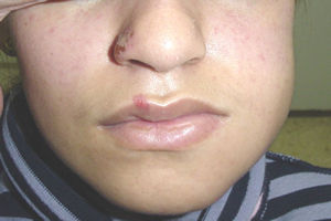 Pulpitis dental