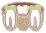 Desplazamiento de los dientes vecinos