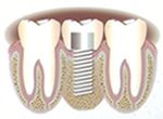 Tipos de prótesis dentales